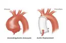 Asendan Aort Genişlemesi Belirtileri ve Tedavisi Asendan Aort Genişlemesi Belirtileri ve Tedavisi