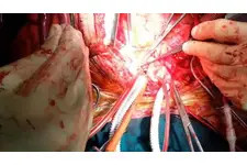 Aort Damarı Ameliyatı Riskleri ve Sonrası Aort Damarı Ameliyatı Riskleri ve Sonrası