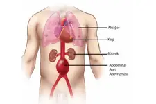 Aort Damarı İncelmesi Belirtileri ve Tedavisi Aort Damarı İncelmesi Belirtileri ve Tedavisi