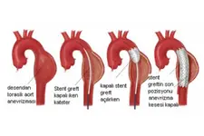 Asendan Aort Belirtileri ve Tedavisi