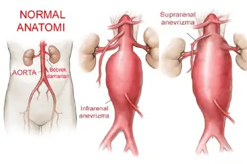 Abdominal Aort Anevrizması Belirtileri ve Tedavisi