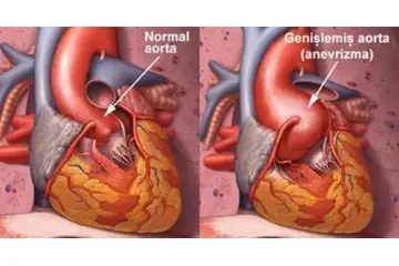 Aort Belirtileri ve Tedavisi